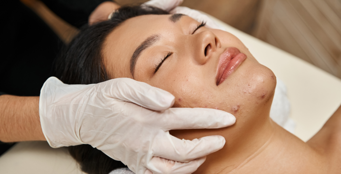 Acne Treatment Facial (1) 1